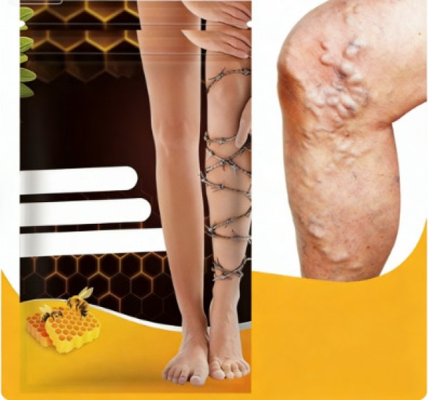 fantasy town Care patch, bee venom vein care patch, varicose veins earthworm leg massage heating patch Foot Pad