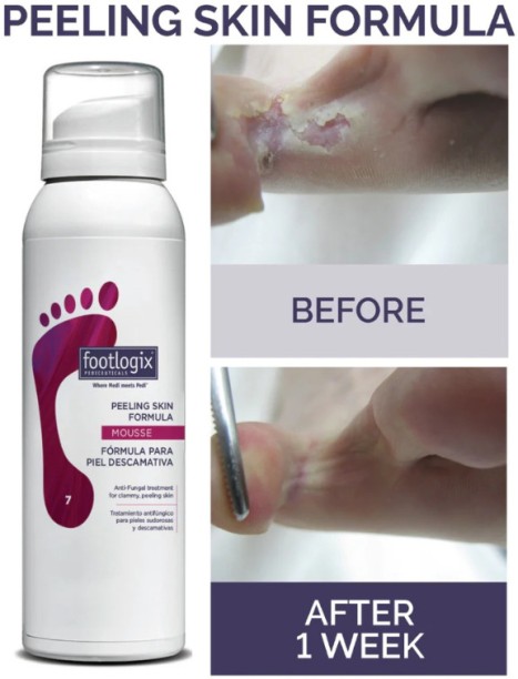 Footlogix Peeling Skin Formula